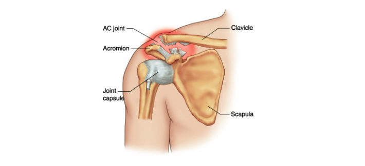 Classification of AC Joint Separation